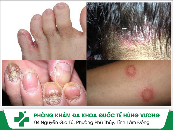 Nấm Da – Đừng Để Một Cái Ngứa Nhỏ Trở Thành Cơn Ác Mộng Lâu Dài