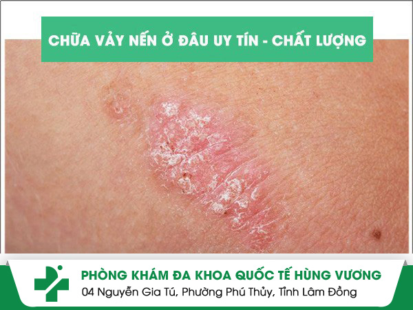 Chữa vảy nến ở đâu uy tín, chất lượng tại TP.HCM