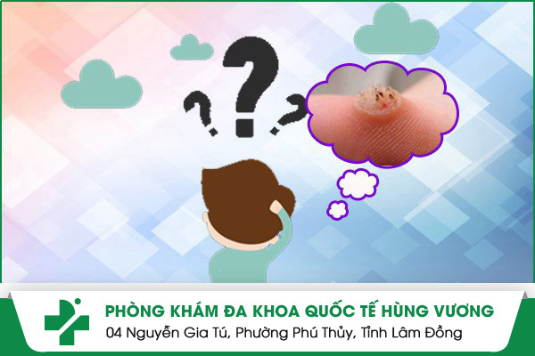 Có Nên Xóa Mụn Cóc Tại Nhà?