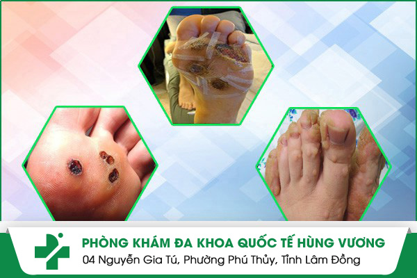 Tự xóa mụn cóc tại nhà gây nhiều biến chứng nguy hiểm 