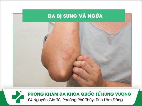 Da bị sưng, ngứa là triệu chứng của bệnh gì?