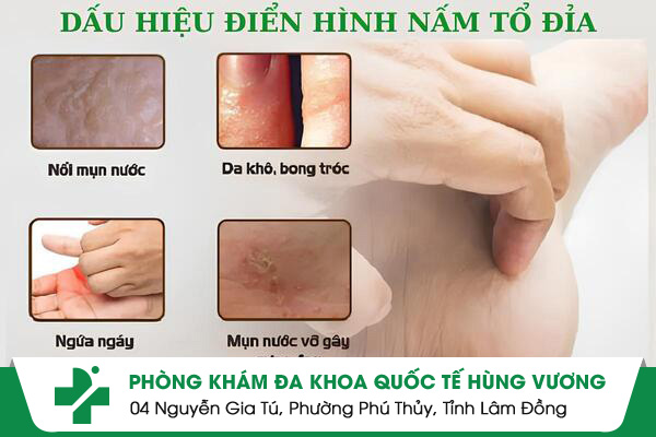 Nấm Tổ Đỉa – Cảnh Báo Bệnh Da liễu Dai Dẳng Nguy Hiểm!