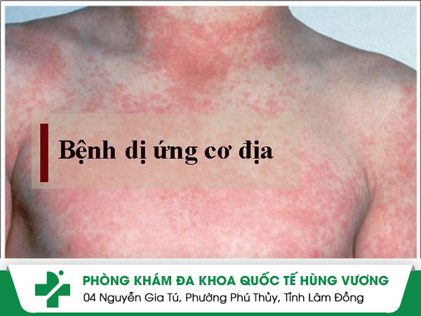 Dị ứng cơ địa nguyên nhân và cách điều trị