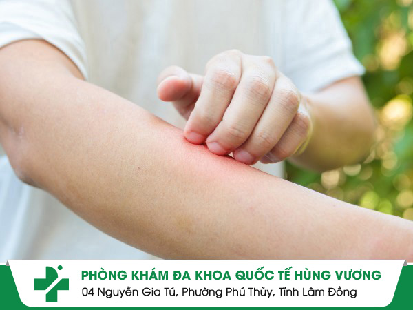 Dị Ứng Da - Đừng Coi Thường Nếu Không Muốn Hối Hận!