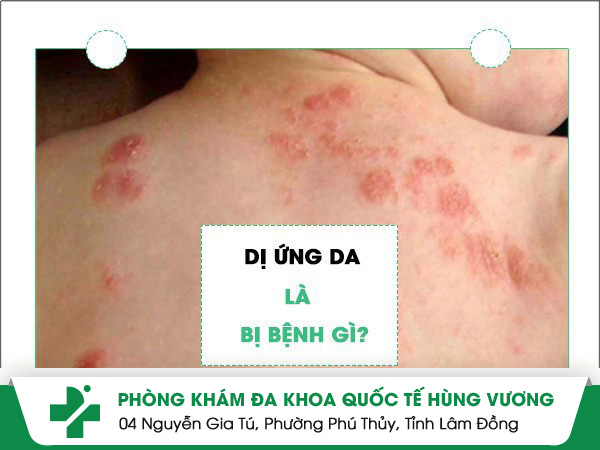 Thường xuyên bị dị ứng là mắc bệnh gì?