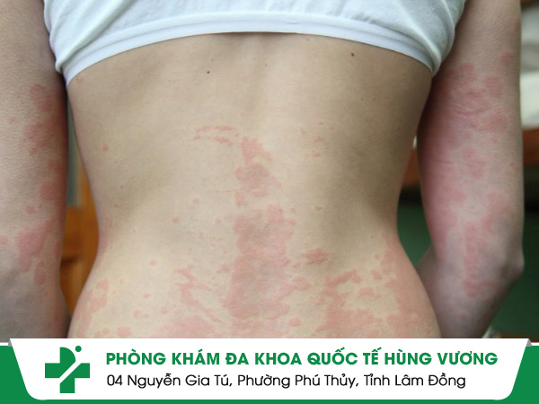 Dị Ứng Mẩn Ngứa: Đừng Chủ Quan Có Thể Biến Chứng Nặng!