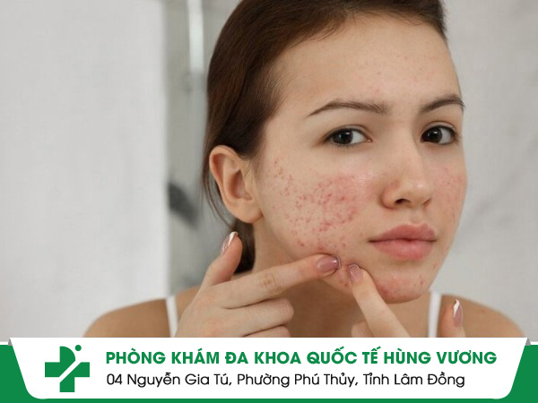 Nguyên nhân và dấu hiệu nhận biết dị ứng mụn