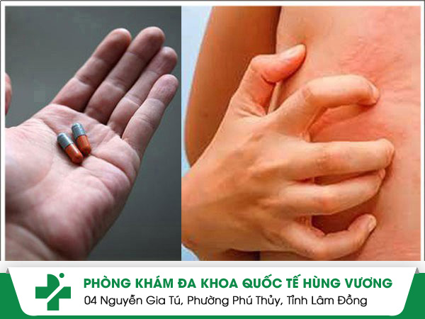 Một số loại thuốc điều trị viêm da dị ứng