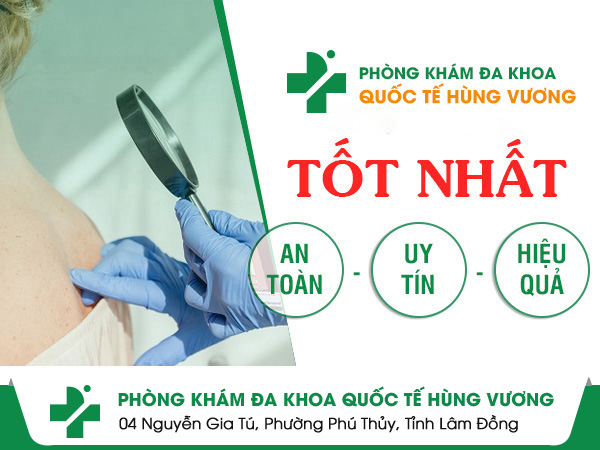 Địa chỉ chữa mề đay uy tín tại TPHCM không lo tái bệnh
