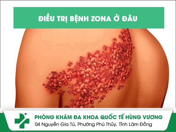 Địa chỉ điều trị bệnh zona uy tín, chất lượng tại TP.HCM