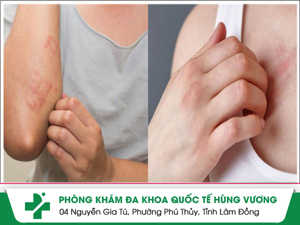 Ngứa Từng Mảng: Bác Sĩ Cảnh Báo Về Các Bệnh Lý Mạn Tính Tiềm Ẩn