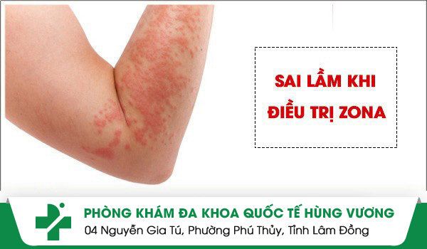 Những sai lầm thường gặp khi điều trị bệnh zona