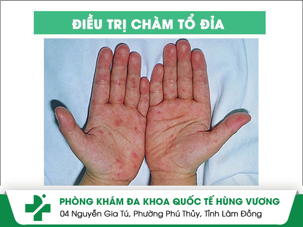 Phương pháp điều trị chàm tổ đỉa không lo tái phát