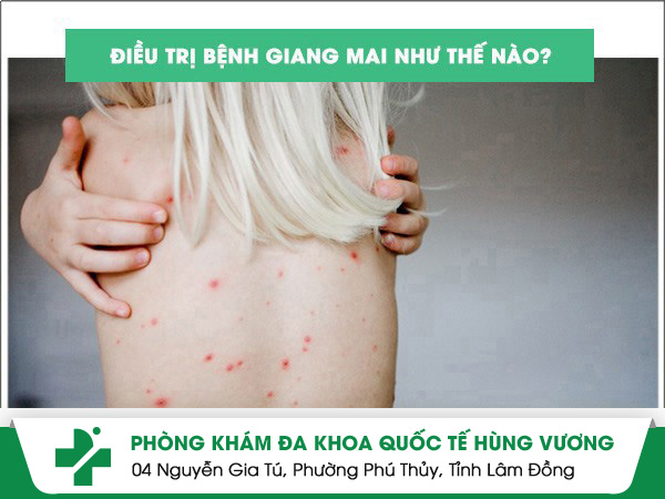 Điều trị giang mai hiệu quả sau một liệu trình