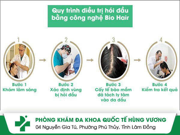 Đột phá điều trị hói bằng phương pháp Bio Hair hiện đại