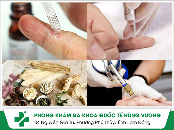 Bất ngờ với cách điều trị mụn hạt cơm hiệu quả và nhanh chóng