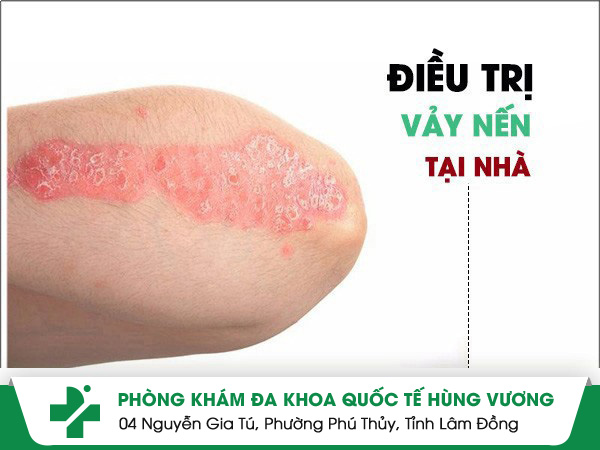 Chữa vảy nến tại nhà liệu có hiệu quả?