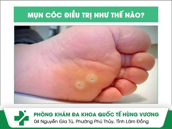 Đốt mụn cóc tại bệnh viện da liễu uy tín chất lượng