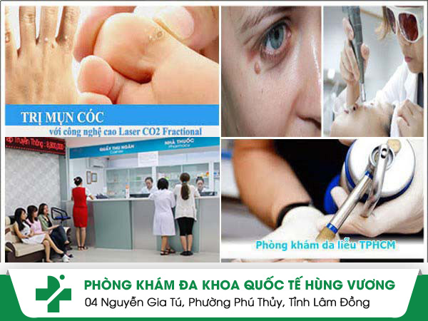 Đốt mụn cóc có đau không?