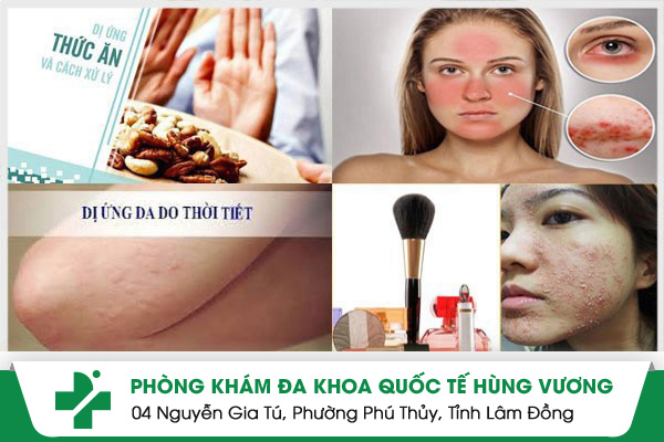 Đừng chủ quan với bệnh dị ứng da