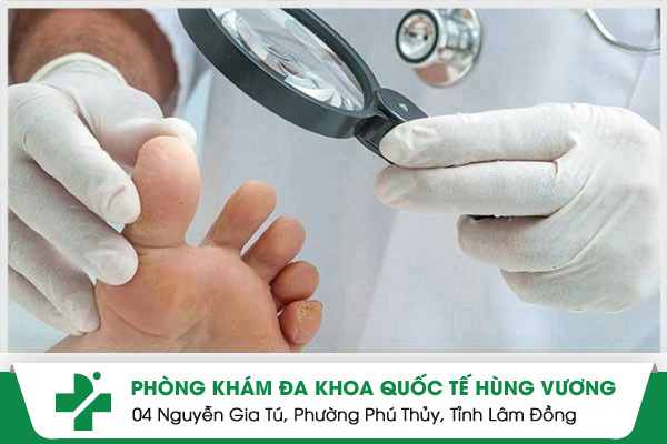 Nấm móng và các vấn đề cần lưu ý