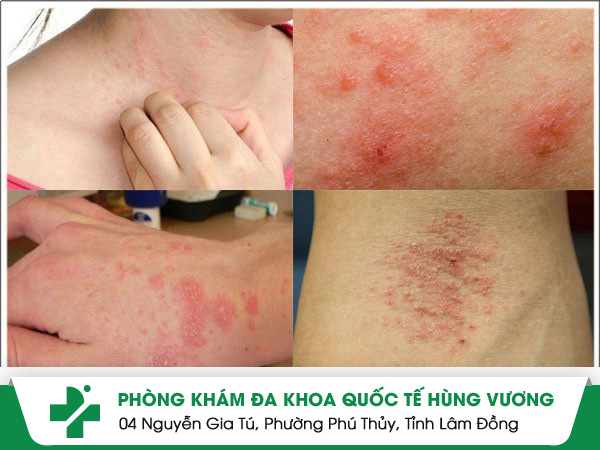 Eczema là bệnh gì? Và cách điều trị hiệu quả