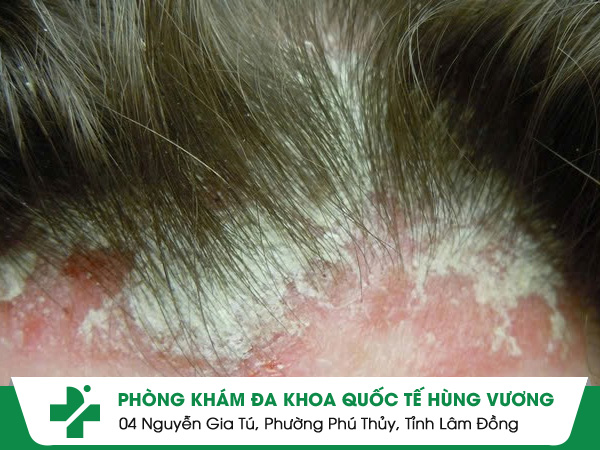 Ghẻ Da Đầu: Căn Bệnh Ngứa Âm Thầm Dễ Nhầm Với Gàu