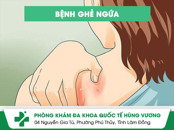 Bệnh ghẻ ngứa và những điều cần biết
