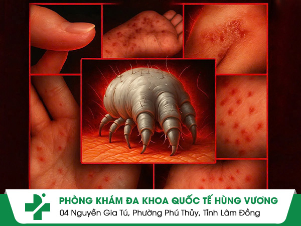 Ghẻ Ngứa: Đừng Xem Thường Kẻ 