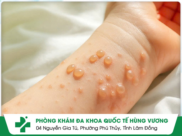 Ghẻ Phỏng – Đừng Để Một Cái Gãi Khiến Làn Da Hủy Hoại