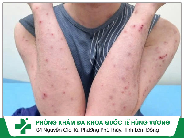 Ghẻ Tay Chân – Ngứa Đừng Gãi, Càng Gãi Càng Lan!