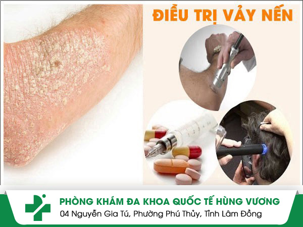 Giải pháp xóa tan bệnh vảy nến bằng phương pháp tiên tiến