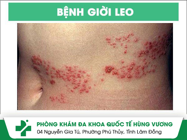 Điều Trị Giời Leo Hiệu Quả Tại Phòng Khám Da Liễu Quận 10 – Hết Nhanh, Không Để Lại Sẹo