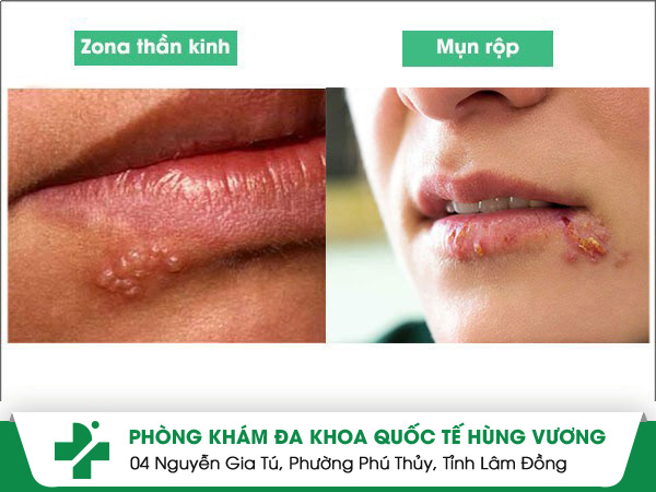 Đánh bại giời leo môi với cách trị cực đơn giản