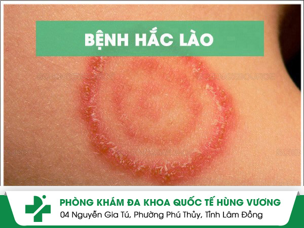 Bệnh hắc lào: nguyên nhân, triệu chứng và cách điều trị