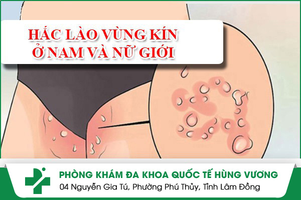 Hắc Lào Vùng Kín Ở Nam Và Nữ Giới – Căn Bệnh Không Thể Xem Nhẹ