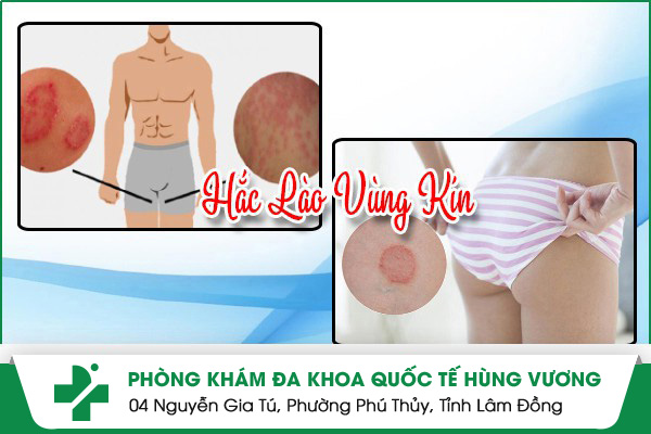 hắc lào vùng kín