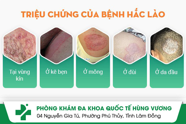 Những điều cần biết về bệnh hắc lào