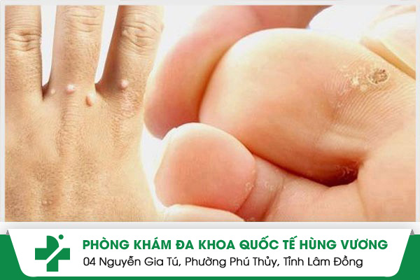 Hạt cơm: Bệnh ngoài da thường gặp