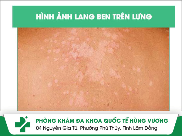 Hình ảnh lang ben ở nhiều người nhận biết như thế nào?