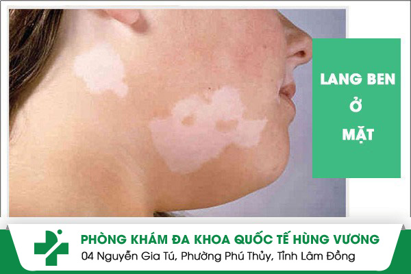 Hình ảnh bệnh lang ben hay gặp ở nhiều người