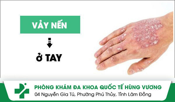 Hình ảnh vảy nến sớm nhận biết để điều trị hiệu quả
