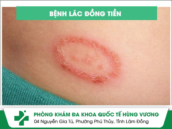 Lác Đồng Tiền – Bệnh Da Liễu Phổ Biến Nhưng Không Nên Xem Thường