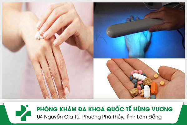 Làm sao điều trị bệnh tổ đỉa hiệu quả?