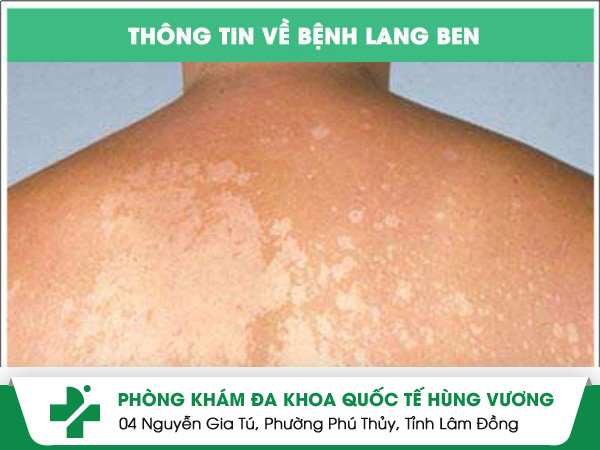 Thông tin về bệnh lang ben và cách điều trị hiệu quả