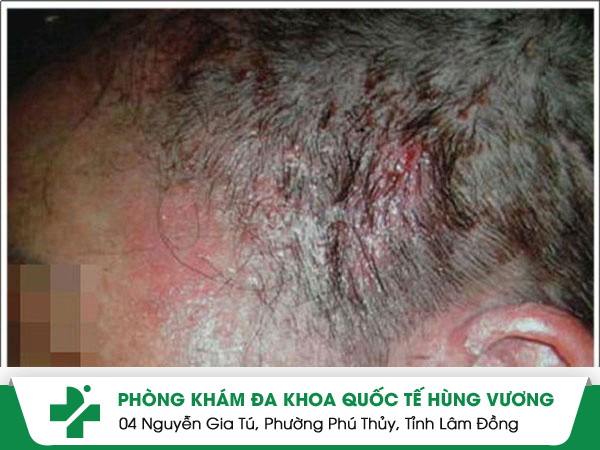 Loét da đầu – triệu chứng của nhiều bệnh lý nguy hiểm