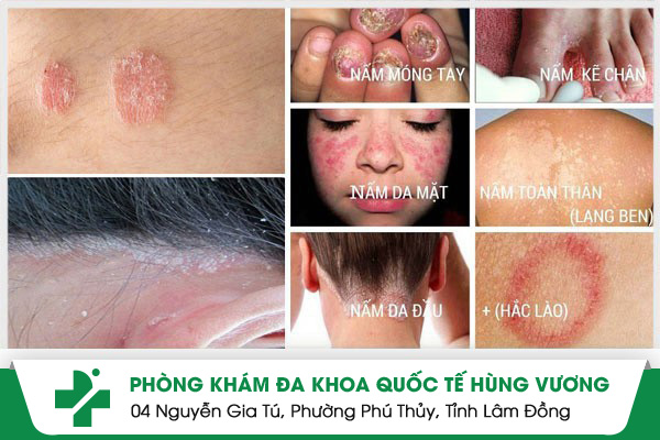 Mách bạn cách nhận biết bệnh nấm và điều trị mang lại hiệu quả nhanh