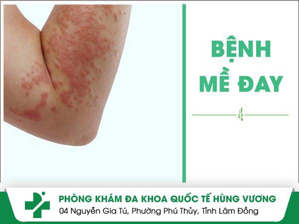 Tổng quan nhận biết bệnh mề đay hay gặp ở nhiều người