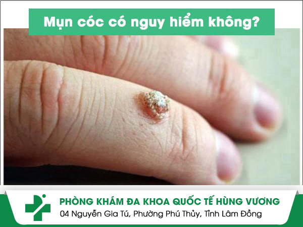 Mụn cóc có nguy hiểm không?