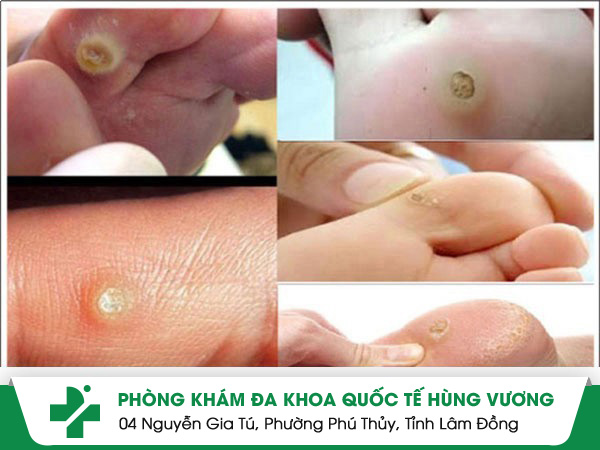 Triệu chứng của bệnh mụn cóc tay chân và cách chữa trị